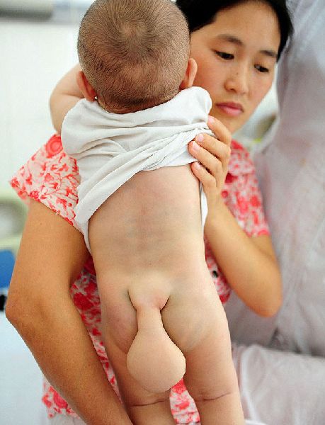 รัดทด! แม่วอนแพทย์ช่วยลูก เกิดมา"มีหาง" หมอ"ส่ายหัว"บอก"ยาก"(ชมภาพ)