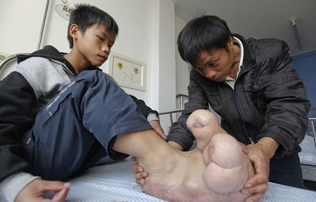 Chinese teen with giant feet gets free treatment
