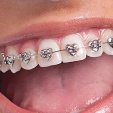 Braces