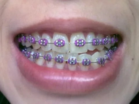 จัดฟันแบบโลหะ Metal Bracket