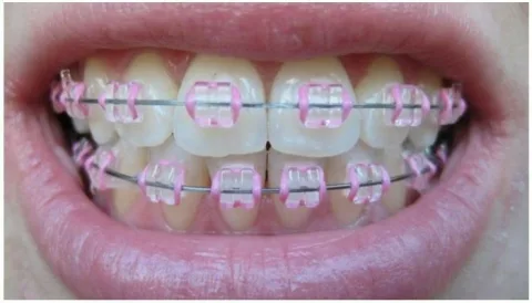 จัดฟันแบบเซรามิก Ceramic braces