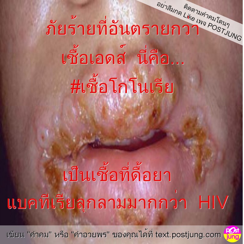 ภัยร้ายที่อันตรายกว่า เชื้อเอดส์ นี่คือ... #เชื้อโกโนเรีย เป็นเชื้อที่ดื้อยา แบคทีเรียลุกลามมากกว่า HIV