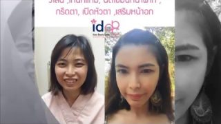 [Review] ศัลยกรรมวีไลน์ ,โหนกแก้ม, ตา, ฉีดไขมันหน้าผาก, เสริมหน้าอก โดยคุณ Suvapak