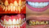 จัดฟัน ที่แท้ฟันเคลื่อนเช่นนี้เอง! Braces Time Lapse