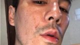 (คลิป) โดม ปกรณ์ ลัม อยู่ในช่วงหน้าพังหนักมาก ล่าสุดโชว์หน้าสดพร้อมเผยใช้สิ่งๆ นี้รักษาหน้า