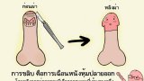 การขลิบ คืออะไร?
