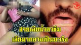 สายเลียน้ำตาซึม! เตือน ใช้ลิ้นกับไหทองคำ เสี่ยงมะเร็งลำคอ