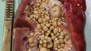 สภาพก้อนนิ่วในไต ของผู้ป่วยรายหนึ่ง..