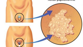 ความสัมพันธ์ของหูดหงอนไก่กับมะเร็งปากมดลูก