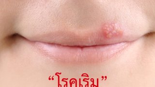 &ldquo;โรคเริม&rdquo; โรคผิวหนังที่ป้องกันได้