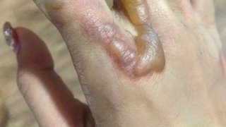 เห็นแล้วเจ็บแทนเลย อาการล่าสุด &ldquo;กระแต อาร์สยาม&rdquo;