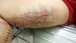 กทม. เมืองที่คนตกท่อ! สาวท้อง 8 เดือนตกท่อ เย็บ42 เข็ม ไร้หน่วยงานติดต่อ ซ้ำใช้สิทธิ30 บ.ไม่ได้