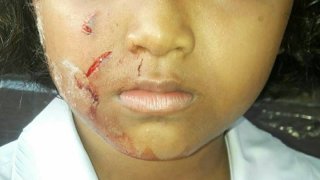 ไร้คนรับผิดชอบ!! ด.ญ.วัย 9 ขวบ ลูบหัวหมาเล่น ถูกกัดหวิดตาบอด แม่เผยอยากให้ รร.ช่วยจัดการเพื่อไม่ให้เกิดขึ้นกับคนอื่น