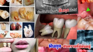 ฟันคุด กับ 10 คำถามสุดฮิต