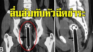 หัวสายฉีดชำระติดอยู่ในรูทวาร! หนุ่มโร่หาหมอ อ้างลื่นล้ม