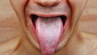 "ลิ้น" บอกโรคทำนายสุขภาพ "ลิ้นเป็นฝ้า" สัญญาณเสี่ยง "ป่วยติดเชื้อ HIV"