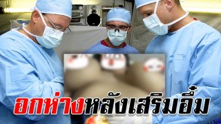 สาวเปิดอกโชว์ หลังเสริมอึ๋มมาแล้ว 3ปี ยิ่งนานยิ่งห่าง?