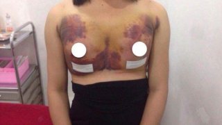 ศัลยกรรมหน้าอกสุดหลอน ลืมผ้าก๊อซไว้ในนม!