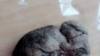 สยอง!! สาวโพสต์มีผ้าก๊อซสีดำ อ้างหมอลืมไว้ในช่องคลอดกว่า 2 เดือน