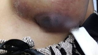 สยอง!! หมอ รพ.ใหญ่ ใส่ซิลิโคนผิดชั้นผิวหนัง จนทำสาวนมเน่าพังทะลุออกนอกเต้า