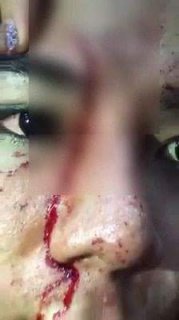 เพจดังโพสต์ข่าว!! ครูสาวอ้างถูกทำร้ายเลือดตกยางออกแผลลึก