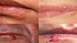 วิธีรักษาโรคเริม ประโยชน์ดีๆอย่าลืมแชร์นะคับ แบ่งความรู้ให้กับผู้อื่นเป็นทานอันประเสริฐ