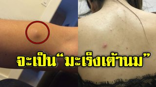 เผย 7 อาการ ผู้หญิงจะเป็น &ldquo;มะเร็งเต้านม&rdquo; ที่หลายๆคนยังไม่รู้