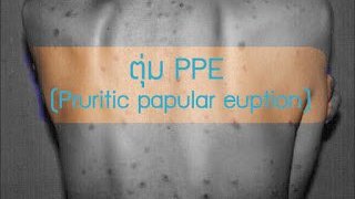 ตุ่ม PPE คืออะไร