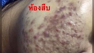 #ภัยร้ายใต้ครีมจากอินเตอร์เน็ต ⁉️