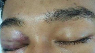 ผู้ใหญ่บ้านโหดร้าย กะยิง ให้ตาบอด ให้ตายทั้งเป็นกับเด็กชายวัย 16​