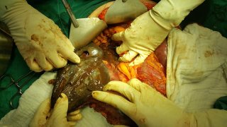 หมอโพสท์เตือนสติ! ใครที่คิดจะกินน้ำยาล้างห้องน้ำประชดชีวิต ไม่ตายง่ายทรมาน ทุรนทุรายสุดๆ!