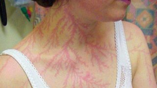 ส่องร่องรอยผู้รอดชีวิตจากการถูกฟ้าผ่า