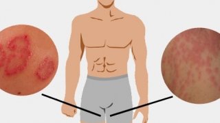 กลุ่มอาการของกามโรคอื่นๆ ที่ไม่ค่อยถูกพูดถึง