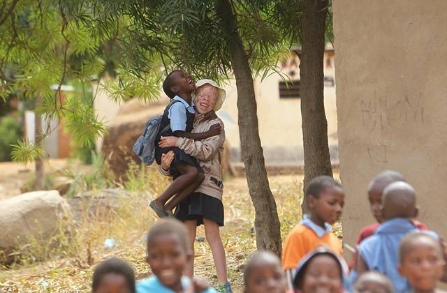 เปิดเรื่องราวของ “เด็กเผือกแอฟริกา” กับชีวิตที่เหมือนถูกคำสาป