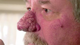 ชายแก่จมูกโตผิดปกติ..จนหลานๆกลัว ร้องแพทย์ผิวหนังชื่อดังช่วยรักษา หวังเปลี่ยนชีวิตใหม่!