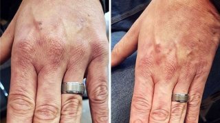 ปกปิดรอบแผลเป็น ด้วยศิลปะ