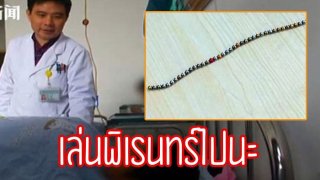 เล่นพิเรนทร์ไปนะ! เด็กชาย 12 ปี ต้องเข้ารับการผ่าตัดเร่งด่วน หลังสอดลูกบอลแม่เหล็กลงในองคชาติตัวเอง