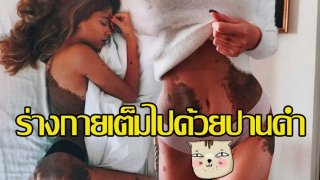 สาวโปแลนด์เลิกซ่อนตัวในเงามืด พร้อมโชว์ภาพร่างกายที่เต็มไปด้วยปานดำ ไม่สนใครมองว่าเหมือนตัวประหลาด