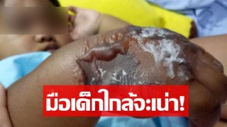 พ่อสุดซ้ำ! โรงพยาบาลดัง สุดชุ่ย ทำมือลูก 1 ขวบบวมเป่ง 3 วัน ยังไร้คนรับผิดชอบ
