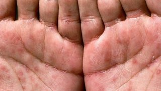 อย่าตื่นตูม"ซิฟิลิส"มารู้จักสาเหตุและวิธีการป้องกันก่อนจะสาย