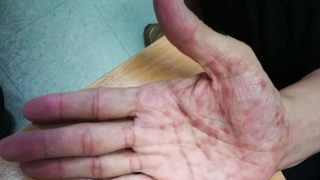 😢เตือนภัยสังคม.ไทยแลนด์2562 ใครมีกิ๊กคู่นอนเพียบ+ไม่ป้องกันระวัง โรคซิฟิลิส😢