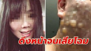 ศัลยกรรมทำพิษ หญิงสาวไปดึงหน้าเสริมสวย กลับเสียโฉมหน้าพุพองเป็นหนอง สุดสยอง