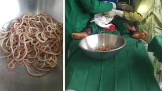 ขนลุกเบาๆ หมอช่วยผ่าตัดนำพยาธิออกจากท้องของเด็ก 4 ขวบ พบไม่เคยถ่ายพยาธิเลยตั้งแต่เกิด