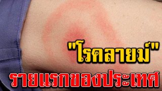 รายแรกของประเทศ หญิงไทยป่วย โรคลายม์ รักษาทัน แต่ความทรงจำหาย