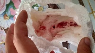 เตือนภัย เด็กเลือดไหลในช่องคลอด พบ ทากดูดเลือด ในช่องคลอดเด็ก กินจนอิ่ม