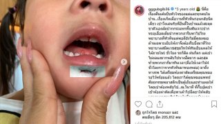 หัวอกแม่ใจจะขาด เป่าเปา ล้มฟันทะลุริมฝีปากเย็บ 15 เข็ม