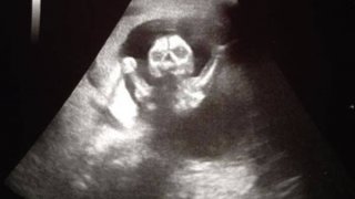 อัลตราซาวด์ดูทารกในครรภ์ แต่ละภาพซ่อนความหลอนอยู่
