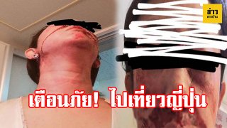 เตือนภัย! สาวโพสต์ภาพบาดแผลถูกทำร้ายเลือดอาบ หลังไปประเทศญี่ปุ่นคนเดียว เผยนาทีถูกชายเข้ามาล็อคคอชก-ตีเข่า ทั้งที่อยู่ในห้องพัก