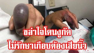 หนุ่มถูกงูกัดนิ้วปล่อยไม่สนใจ เดี๋ยวก็หาย สุดท้ายบวมเป่งเป็นสีม่วง