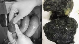 หนุ่มปวดท้องสาหัส หมอเจอก้อนแป้งอุดลำไส้ คนไข้สารภาพ กินชานมไข่มุก แทนอาหาร 3 มื้อ